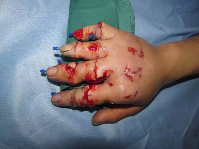 手指软组织挫伤图片