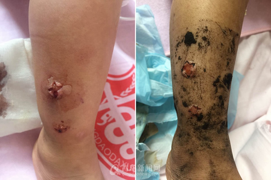 2岁女童被毒蛇咬伤 抢救5天捡回命