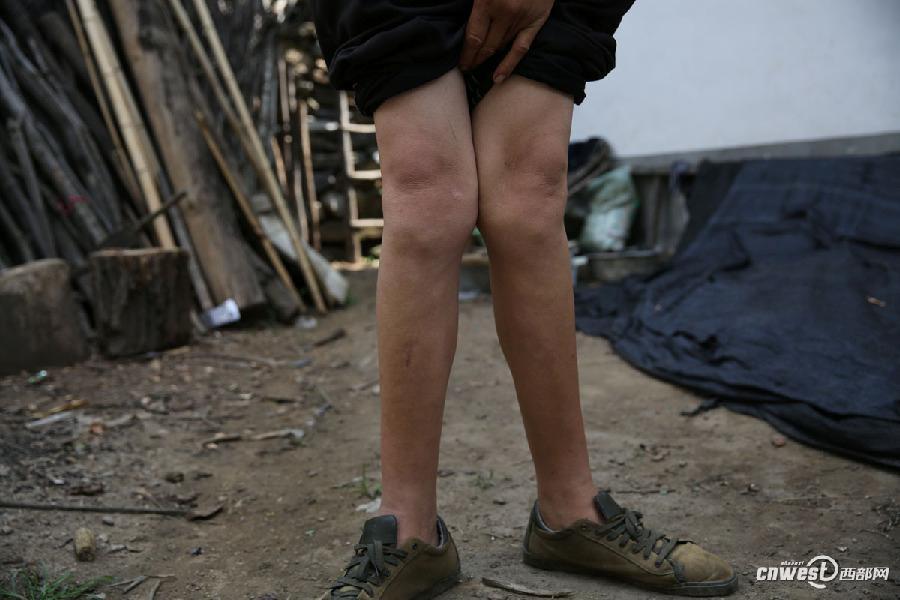 陕西男子身高2米13还在长家庭贫困无钱医治